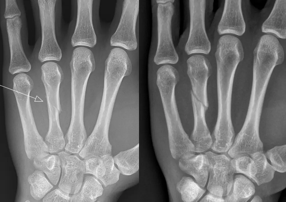 Deux radiographies de main